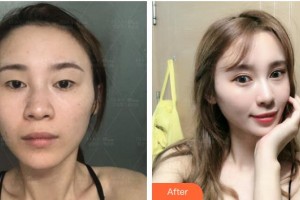 上海瑪麗醫(yī)院整形美容中心謝宏德整形價格表附切開雙眼皮案例展示