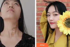 上海交通大學(xué)附屬瑞金醫(yī)院燒傷整形科董鶴亮整形價格表附燙傷疤痕修復(fù)案例展示