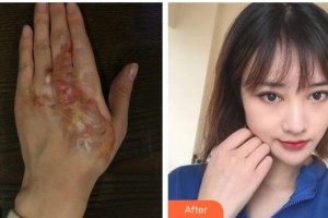 上海交通大學(xué)附屬瑞金醫(yī)院燒傷整形科方培耀整形價格表附燙傷疤痕案例展示