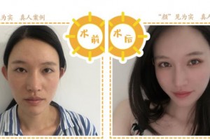 上海市第一人民醫(yī)院整形外科沈尊理整形價格表附埋線雙眼皮案例展示