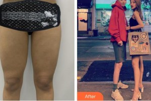 上海復(fù)旦大學(xué)附屬華山醫(yī)院整形外科周兆平整形價格表附大腿吸脂案例展示