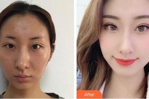 上海市第一人民醫(yī)院整形外科黃一雄整形價格表附顴骨內(nèi)推案例展示