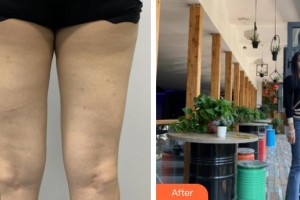 上海第二軍醫(yī)大學(xué)附屬長征醫(yī)院整形外科朱曉海整形價格表附大腿吸脂案例展示