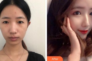 上海第二軍醫(yī)大學(xué)附屬長征醫(yī)院整形外科章建林整形價格表附桃花美眼案例展示