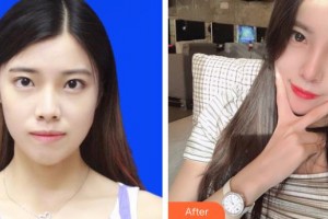 上海第二軍醫(yī)大學(xué)附屬長海醫(yī)院整形外科陳江萍整形價格表附肋軟骨隆鼻案例展示