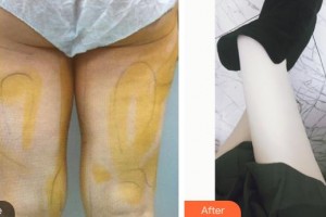 上海第八人民醫(yī)院美容整形科黃杰整形價格表附吸脂案例展示