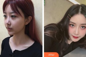 上海伊美爾港華醫(yī)療美容醫(yī)院師麗麗整形價格表附隆鼻案例展示