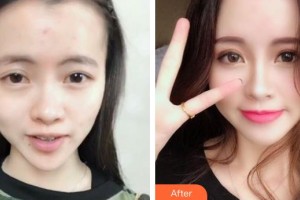 上海第二軍醫(yī)大學(xué)附屬長海醫(yī)院整形外科郭恩覃整形價格表附面部填充案例展示