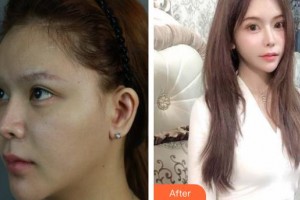 上海伊萊美醫(yī)療美容醫(yī)院王世專整形價格表附顴骨顴弓降低案例展示