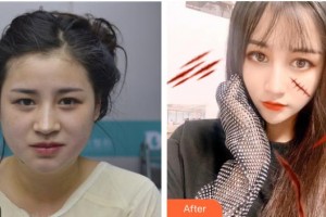 煙臺華怡醫(yī)學(xué)美容醫(yī)院張上海整形價格表附面部光纖案例展示