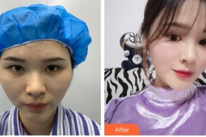 上海時光整形外科醫(yī)院李靜林整形價格表附鼻部手術(shù)案例展示