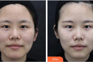 上海德琳醫(yī)療美容醫(yī)院李鎬均整形價格表附激光祛斑案例展示