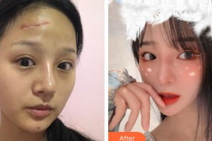 上海美爾雅醫(yī)療美容醫(yī)院衛(wèi)連坤整形價格表附離子束祛疤案例展示