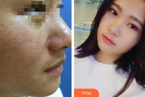 上海美之仁醫(yī)療美容醫(yī)院張倩倩整形價格表附微針美塑案例展示