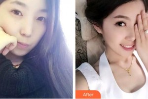 上海常亮醫(yī)療美容診所蔣春梅整形價格表附提眉術(shù)案例展示