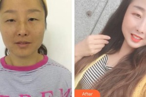 上海原辰醫(yī)療美容醫(yī)院李科整形價(jià)格表附重瞼+內(nèi)眥+提肌案例展示