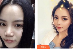 上海文峰醫(yī)療美容門診部楊?；菡蝺r(jià)格表附微針祛痘案例展示