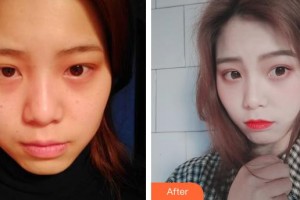 上海百達(dá)麗醫(yī)療美容醫(yī)院張程整形價(jià)格表附激光美膚激光案例展示