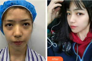 廣州時光整形美容醫(yī)院鐘涌濤整形價格表附面部埋線提升案例展示