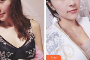 廣州美萊醫(yī)療美容醫(yī)院羅延平整形價格表附濃縮豐胸案例展示