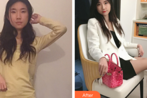 廣州遠東美容醫(yī)院洪冰瑩主診醫(yī)師整形價格表附玻尿酸導(dǎo)入精華案例展示