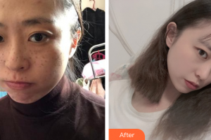 廣州凱美達整形美容醫(yī)院郭沙雅整形價格表附激光祛斑案例展示