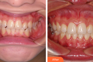 廣州利美康粵美醫(yī)療美容門診部艾虹整形價格表附牙齒正畸案例展示