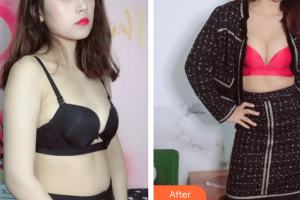 廣州韓妃醫(yī)學(xué)美容醫(yī)院黃招標整形價格表附濃縮豐胸案例展示