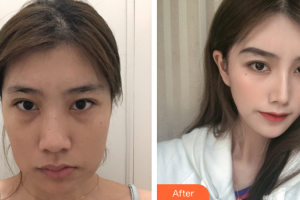 廣州軍美整形醫(yī)院趙希純整形價格表附面部輪廓案例展示