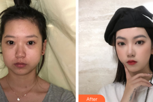 廣州博仕整形美容醫(yī)院韓東均整形價格表附下頜骨磨角案例展示