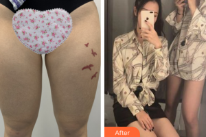 廣州美瑞兒醫(yī)療美容門診部崔錫珉整形價格表附大腿吸脂案例展示