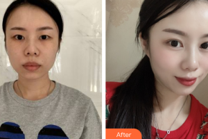廣州中科美整形醫(yī)院張金明整形價格表附眼部綜合案例展示