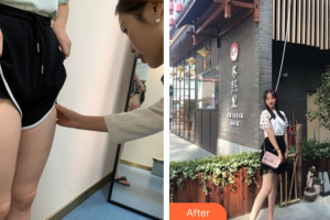 廣州荔醫(yī)醫(yī)療美容門診部鄧正軍整形價(jià)格表附大腿吸脂案例展示