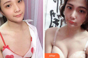 廣州利美康粵美醫(yī)療美容門診部范建輝整形價(jià)格表附自體脂肪隆胸案例展示