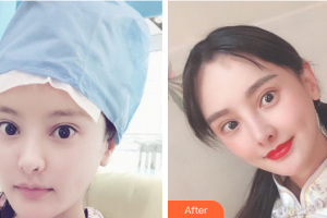 廣州慕美醫(yī)療美容醫(yī)院成紅整形價(jià)格表附發(fā)際線種植案例展示