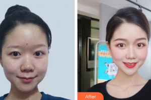 廣州韓妃醫(yī)學(xué)美容醫(yī)院孫華整形價(jià)格表附激光祛斑案例展示