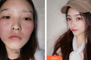 廣州利美康粵美醫(yī)療美容門診部龔麗珍美容科激光師整形價(jià)格表附皮膚管理案例展示