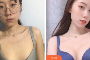 廣州市第一人民醫(yī)院整形美容中心王原路整形價(jià)格表附濃縮豐胸案例展示