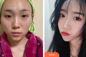 廣州中家醫(yī)家庭醫(yī)生醫(yī)學(xué)整形美容醫(yī)院龍曉枚整形價(jià)格表附顴骨內(nèi)推案例展示