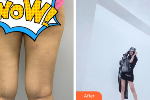 廣州海峽醫(yī)學(xué)整形美容醫(yī)院郭棟整形價(jià)格表附大腿吸脂案例展示