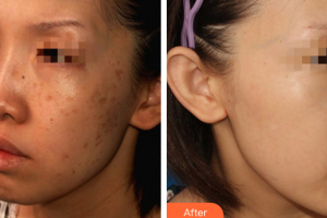 廣州美恩整形美容醫(yī)院許滿萍整形價(jià)格表附曬斑調(diào)節(jié)案例展示