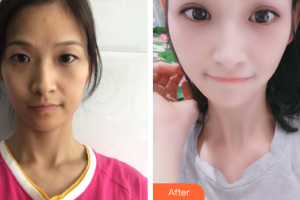 廣州中家醫(yī)家庭醫(yī)生醫(yī)學(xué)整形美容醫(yī)院鄭昱喆整形價(jià)格表附蘿莉美萌眼案例展示