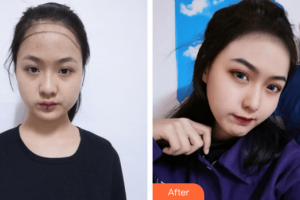 廣州韓妃醫(yī)學(xué)美容醫(yī)院萬麗整形價(jià)格表附發(fā)際線種植案例展示