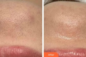 上海宏康醫(yī)院整形美容中心馮志毅整形價(jià)格表附白瓷案例展示