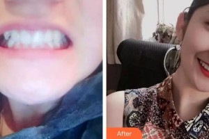 上海伯思立醫(yī)療美容門診部印志民整形價(jià)格表附牙齒做美容案例展示