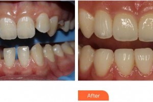 上海華美醫(yī)療美容醫(yī)院季文娟整形價(jià)格表附牙齒隱形矯正案例展示