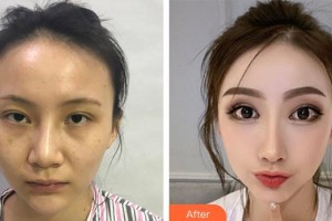上海百達(dá)麗醫(yī)療美容醫(yī)院趙平萍整形價格表附鼻部手術(shù)整形案例展示