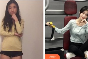 上海解放軍第四五五醫(yī)院激光整形科羅玲整形價格表附玻尿酸導(dǎo)入案例展示