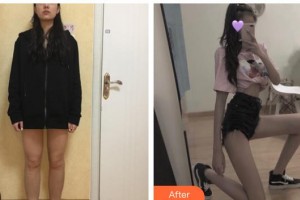 上海東方麗人美容醫(yī)療醫(yī)院劉洋整形價格表附大腿吸脂案例展示