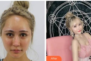 上海仁愛醫(yī)院整形美容科張少博整形價格表附酒窩案例展示